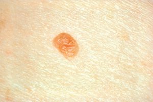 Esperanza de cura para el melanoma