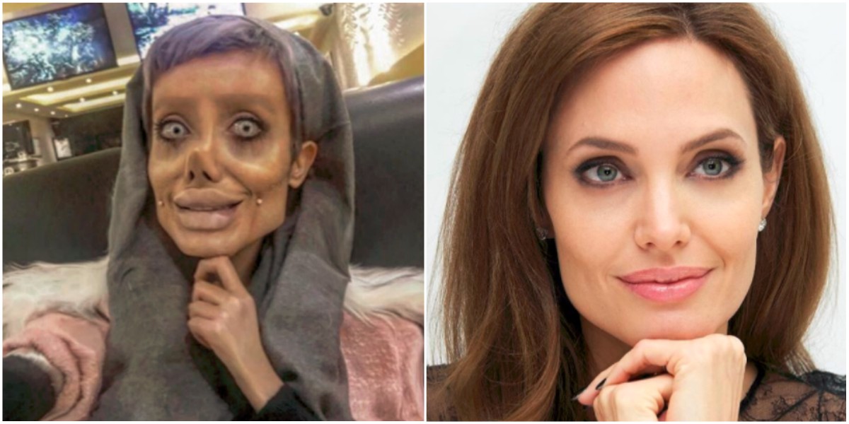 La trágica situación de la mujer que se operó para parecerse a Angelina Jolie