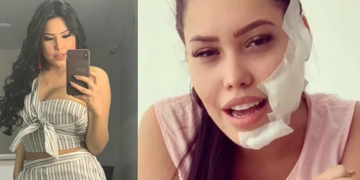 Con múltiples heridas en su cara, la cantante Ana del Castillo relata dolorosos detalles de su accidente