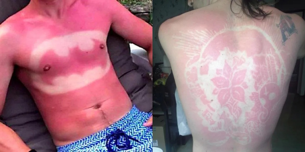 Fotos del &#8220;Sunburn Art&#8221;: la moda de tatuarse con el sol que preocupa a las autoridades