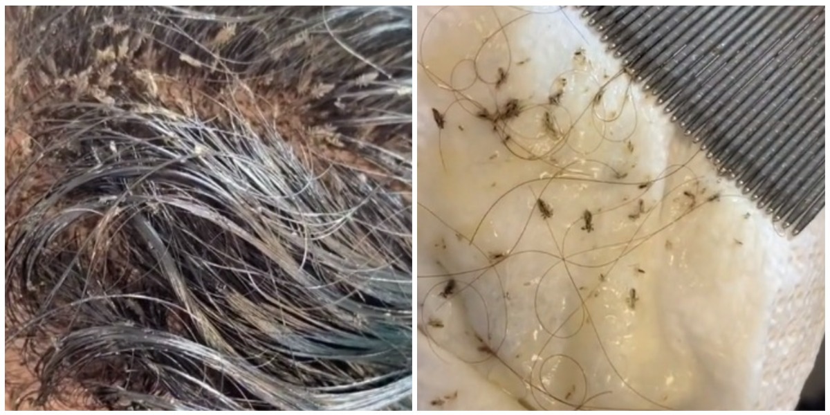 Niña tiene más de 15.000 piojos en su cabeza Canal 1