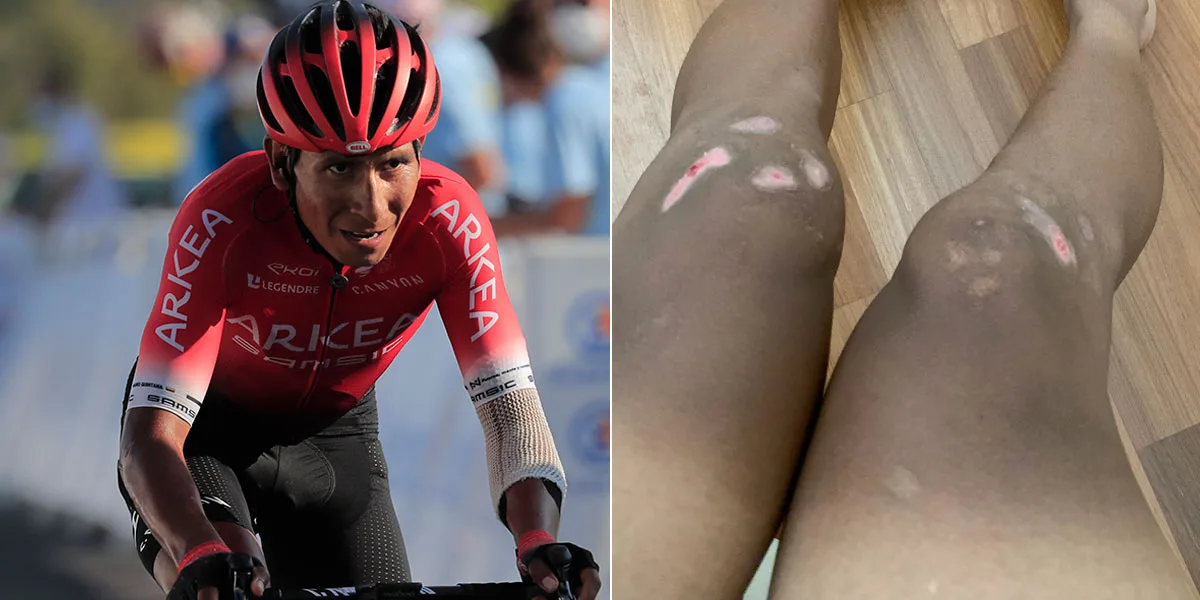 El ciclista Nairo Quintana fue sometido a cirugía en ambas rodillas