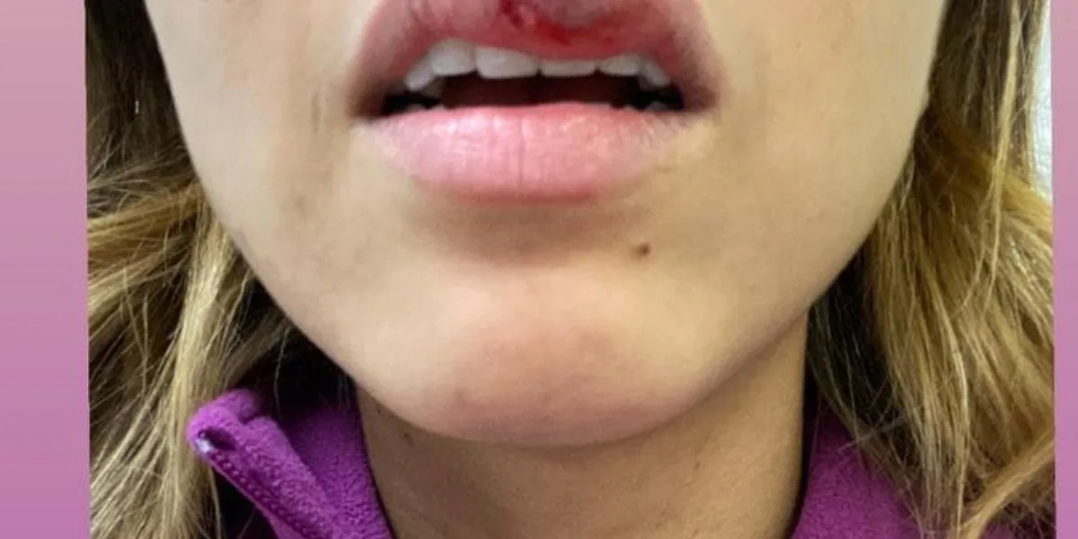Presentadora colombiana fue atacada en la cara por su perro