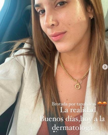 Daniela Ospina acné