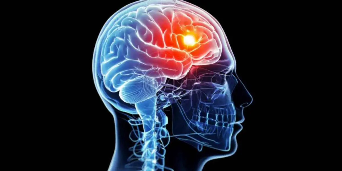 Accidentes cerebrovasculares: cada segundo cuenta para salvar una vida