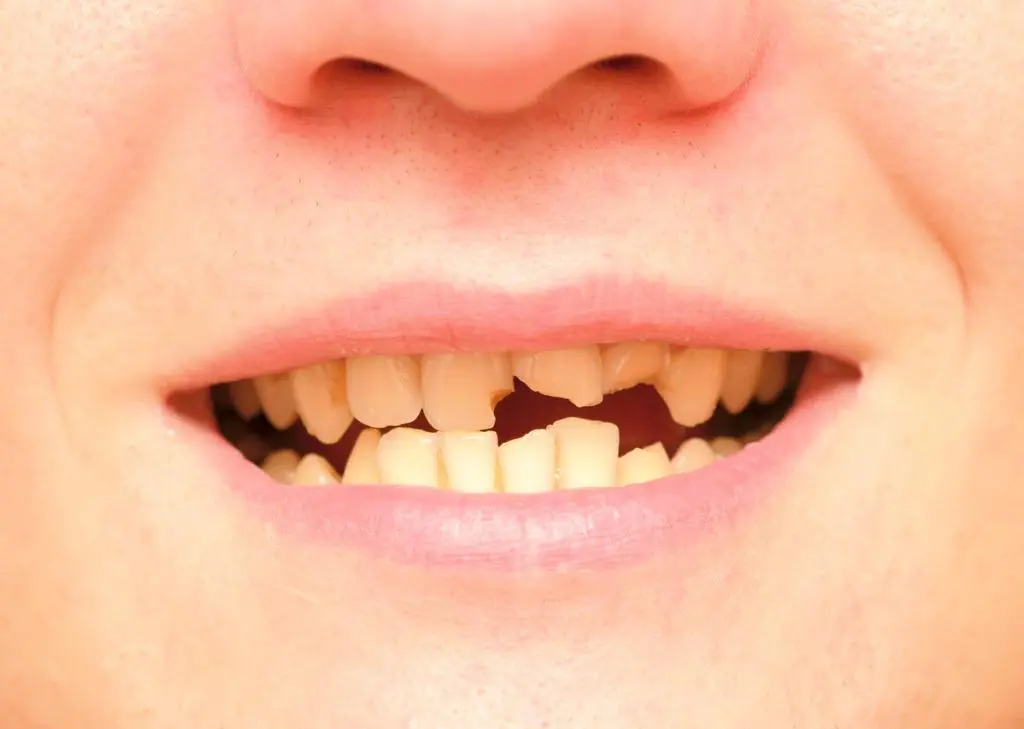 foto de dentes trincados