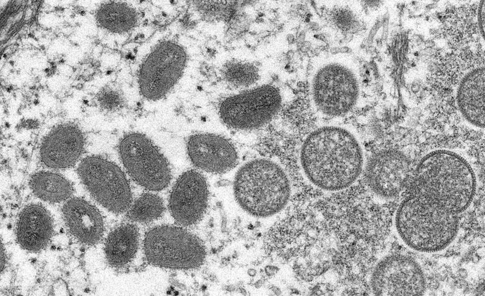OMS anticipa que aparecerán más casos de la viruela del mono - Noticentro 1  CM&