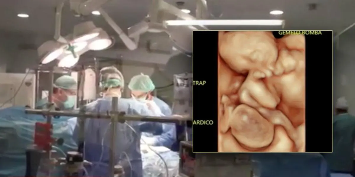 Increíble procedimiento: separan a gemelos en el vientre de su madre en Barranquilla