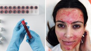 Tres mujeres se contagian de VIH por tratamientos faciales vampiro
