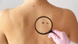 Médicos le hicieron insólito diágnostico a joven que en realidad tenía cáncer de piel