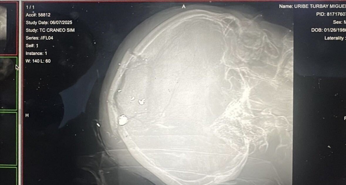 Se filtran las presuntas radiografías del precandidato Miguel Uribe así se ve su lesión